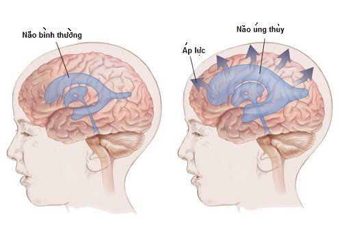 
Có rất nhiều trường hợp có thể chỉ định dẫn lưu não thất ổ bụng.
