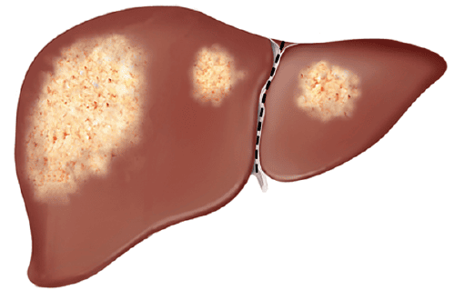 Is calcification in the liver dangerous?