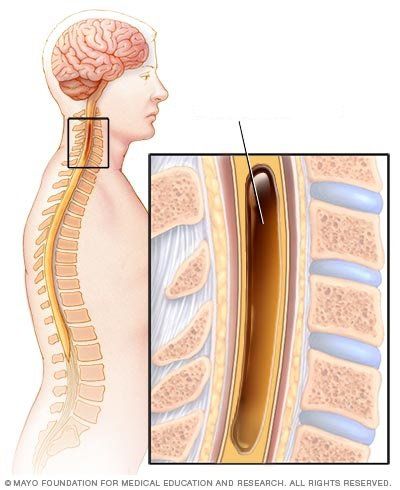 Can a voiding be diagnosed with an MRI scan?