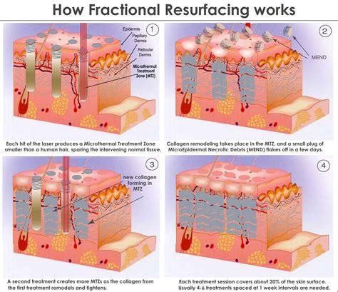 Fractional CO2 laser skin rejuvenation