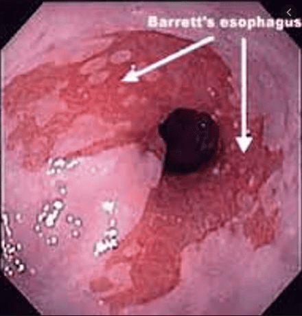 
Hình 4: Hình ảnh Barrett's thực quản
