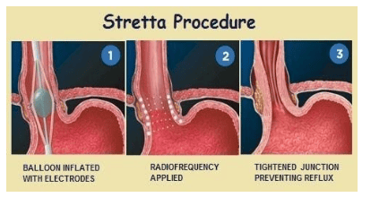 
Kỹ thuật Stretta
