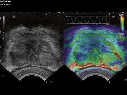 
Elastography là một loại xét nghiệm hình ảnh giúp kiểm tra tình trạng xơ hoá gan.
