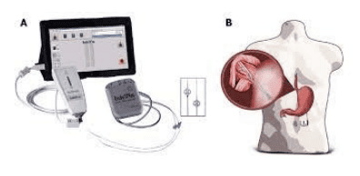 
Hệ thống kích thích điện trong điều trị bệnh lý GERD
