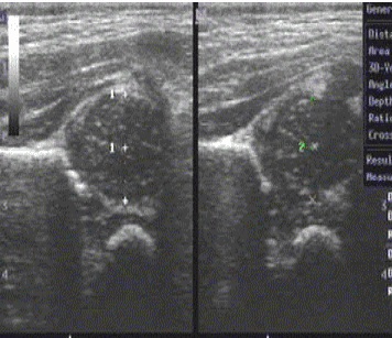 
Hình 2. Hình ảnh siêu âm khớp háng trẻ em.
