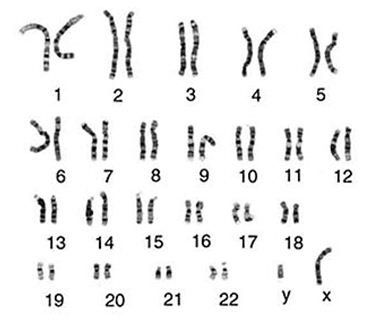 Trẻ xét nghiệm phát hiện vi mất đoạn trên nhiễm sắc thể số 14 del(14)(q11,2) là sao?