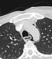 Boerhaave syndrome - Perforation of the esophagus due to vomiting