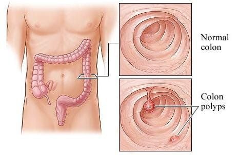 Having removed 3 colon polyps 1 week but still having abdominal pain after eating with black stools, do I need a colonoscopy again?