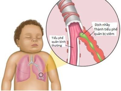 Beware of children wheezing due to soft laryngeal cartilage