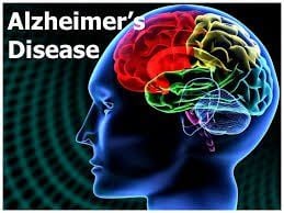 Bài tập phục hồi chức năng nào cho bệnh nhân 75 tuổi bị Alzheimer giai đoạn cuối?