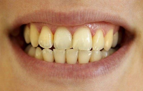 How do drugs make teeth discolored?