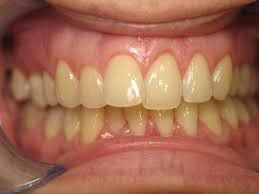 Causes of discolored teeth