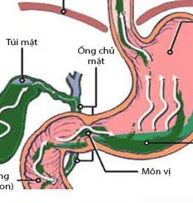 How to get rid of bile?