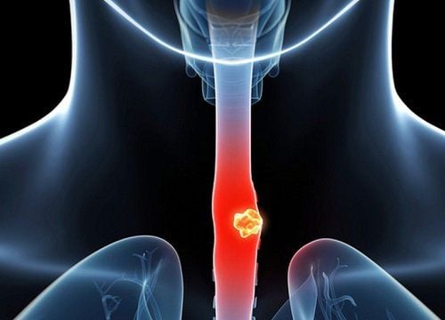 Should esophageal papillomatosis be removed?