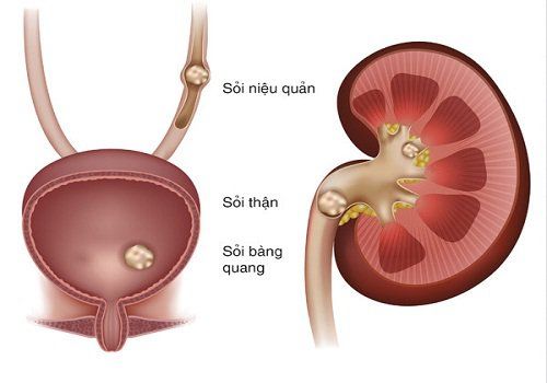 Giãn đài bể thận độ 1 kèm sỏi thận 12mm nên mổ hay điều trị bằng thuốc?