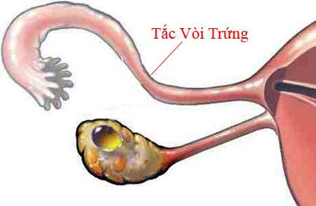 
Tắc vòi trứng
