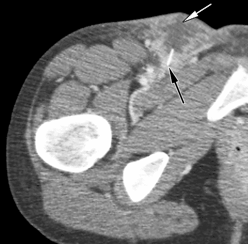 Imaging features of subcutaneous abscesses