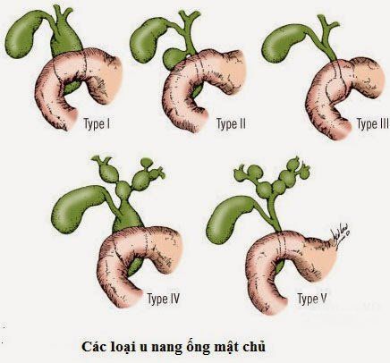 Bệnh u nang ống mật chủ và nguyên nhân gây bệnh