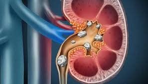 There are 3 stones in the renal pelvis and the upper calyx can be lithotripsy outside the body?