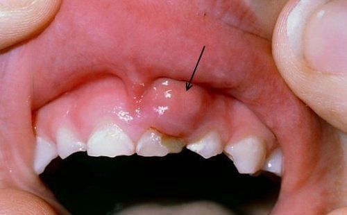 Trẻ sưng lợi răng hàm trên có sao không?