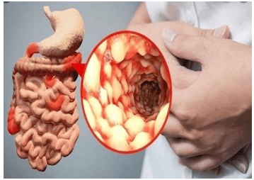 
Hình ảnh bệnh Crohn
