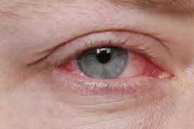 Nhức mắt sau mổ viêm giác mạc phải làm gì?