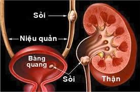 Tán sỏi niệu quản ngược dòng có vết mổ không?