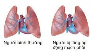 Is there any way to relieve cough for patients with pulmonary hypertension?