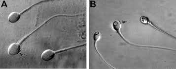 
A. Tinh trùng bình thường B. Tinh trùng có không bào ở đầu
