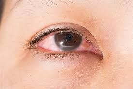 Thuốc của bạn có gây khô mắt không?