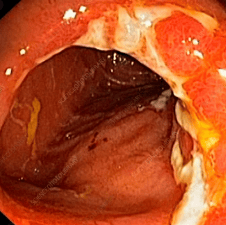 
Hình ảnh bệnh Crohn ở hồi tràng được nhìn thấy qua nội soi với nhiều ổ loét
