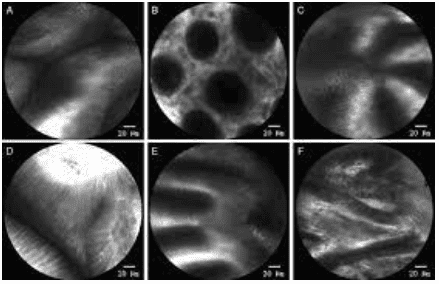 
Hình ảnh nội soi phóng đại bằng Laser đồng tiêu
