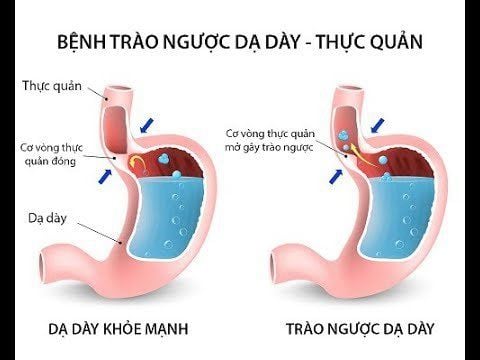 Thuốc nào đặc trị trào ngược dạ dày?