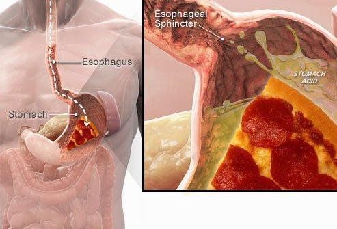 
Cơ thắt thực quản dưới đóng vai trò quan trọng trong bệnh lý GERD
