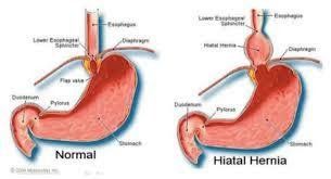 
Thoát vị khe hoành cũng là yếu tố làm bệnh viêm thực quản trào ngược khó điều trị
