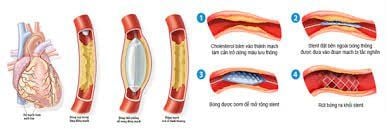 
Nong và đặt stent động mạch vành
