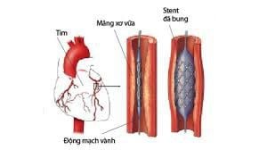 
Phân tích cho thấy đặt stent phủ thuốc an toàn hơn so với các loại stent khác
