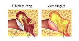 
Viêm tai giữa có thể khiến người bệnh nghe kém
