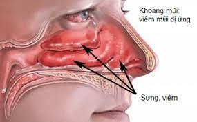 
Viêm mũi dị ứng và cảm lạnh có những biểu hiện giống nhau
