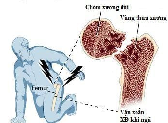 
Vị trí gãy xương hông hay gặp nhất là gãy dưới chỏm xương đùi và gãy liên mấu chuyển.
