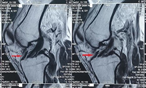 
MRI khớp gối là một công cụ chẩn đoán quan trọng bổ trợ cho các đặc điểm lâm sàng của sụn chêm hình đĩa.
