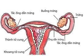 Đau lưng kèm đau mông sau mổ thông tắc vòi trứng có sao không?