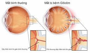Cách chăm sóc mắt sau phẫu thuật glocom cắt bè củng giác mạc?