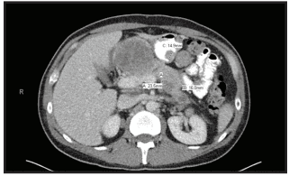 
Chụp CT Scan bụng cho thấy phúc mạc của ổ bụng bị xâm lấn dọc theo vách sau dạ dày và một nốt 1,5 cm trên mặt sau của hang vị dạ dày.
