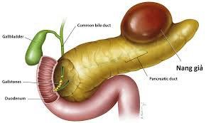 What to eat with acute pancreatitis with pseudocyst complications?