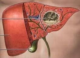 High fever after sucking pus and putting a tube to drain the lung is okay?