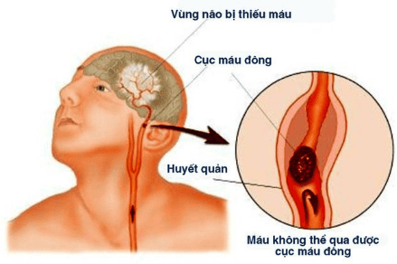 
Xử trí đột quỵ thiếu máu não giai đoạn cấp
