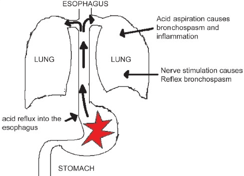 
Nhiều bệnh lý ở hệ hô hấp có liên quan đến viêm thực quản trào ngược
