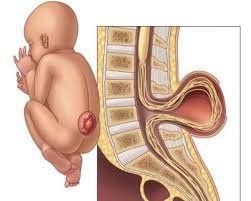 
Cấu trúc túi thoát vị màng não tuỷ bắt nguồn từ một cung thần kinh bị khiếm khuyết
