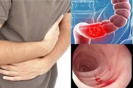 How is ulcerative colitis diagnosed?